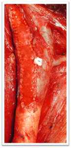 Stenosi carotidea: sintomi, cause e trattamento