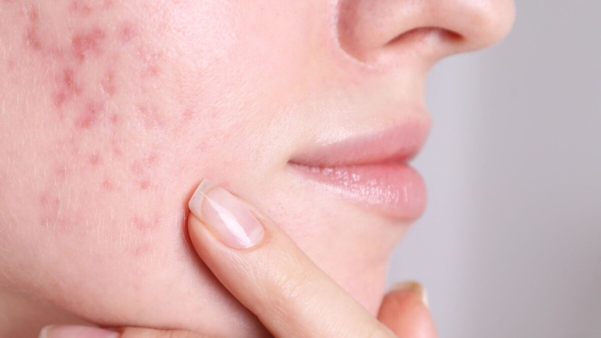 Acne tardiva cause